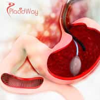 Non-Surgical Gastric Balloon Treatment in Mexico for U.S. Patients